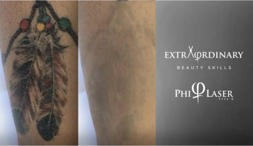 Een tatoeage op een onderarm voor en na het verwijderen met de PhiLaser