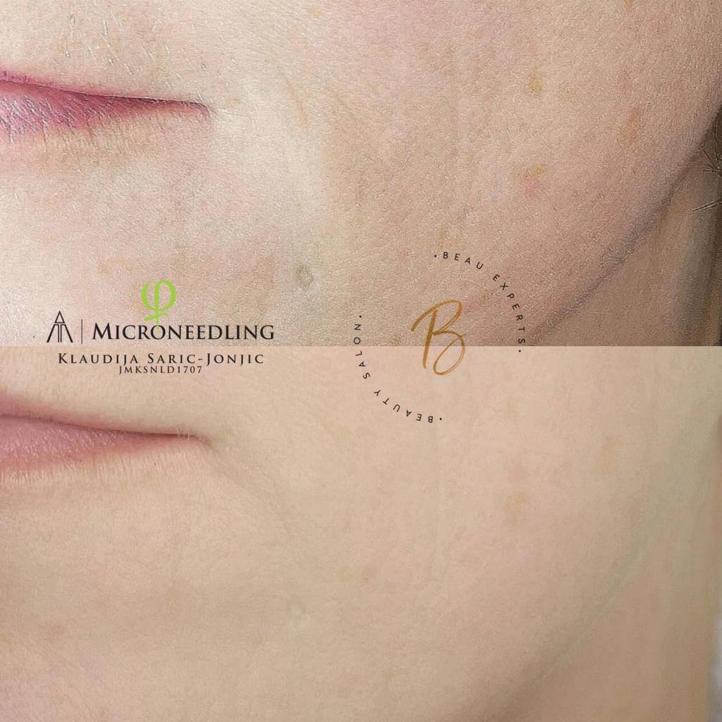 Huid voor en na microneedling