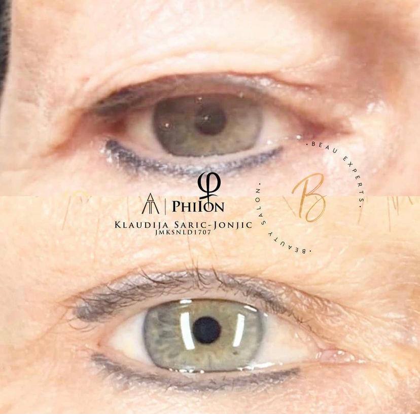 Een oog voor en na een Phi-Ion-behandeling